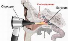 Viêm tai giữa mạn tính có cholesteatoma